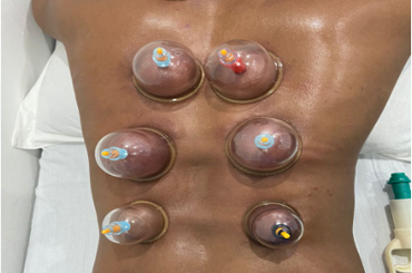 cupping therapy Gurgaon